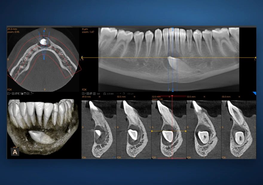 Visualização por cortes de um canino incluso em CBCT 3D