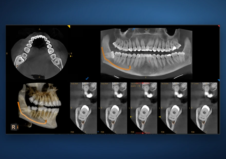 Exame CBCT 3D no software — vistas axial, panorâmica, reconstrução 3D e cortes