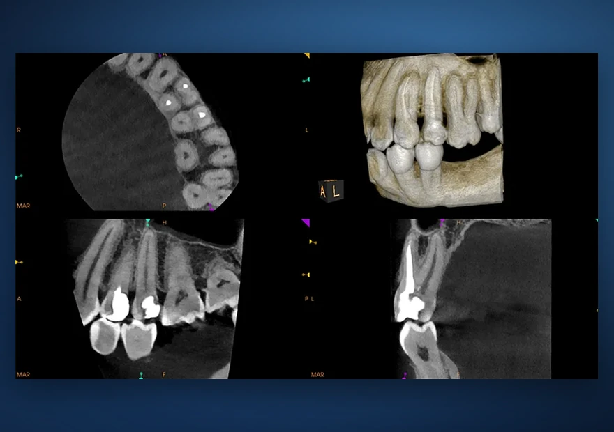Imagem de CBCT 3D digital de alta definição e baixa dose