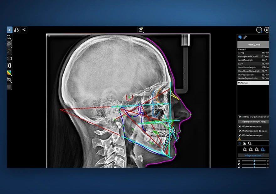 Telerradiografia de perfil com traçado cefalométrico para ortodontia
